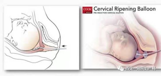 子宫球囊怎么取临床上常用的促宫颈成熟方法---COOK球囊和欣普贝生_https://www.jmylbn.com_新闻资讯_第1张