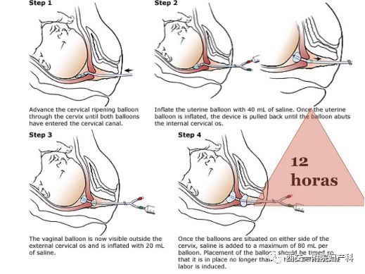 子宫球囊怎么取临床上常用的促宫颈成熟方法---COOK球囊和欣普贝生_https://www.jmylbn.com_新闻资讯_第2张