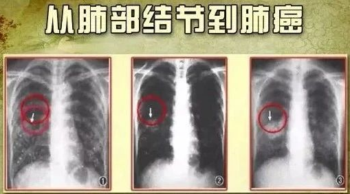 肺部结节 肺部结节