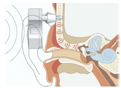 案例分享 | 用 MSC Nastran 和 MARC 仿真让医学创新更上一层楼的图4