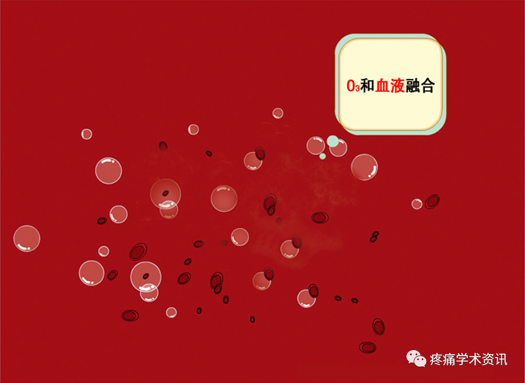 什么是臭氧大自血疗法臭氧大自血治疗好处多，但这些人群最好都别碰_https://www.jmylbn.com_新闻资讯_第4张