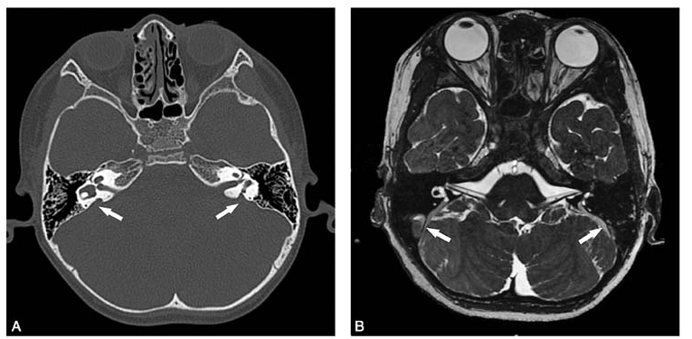 颞骨高分辨率ct示双侧前庭导水管扩大并与前庭池相通(图1a).