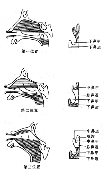 耳鼻喉头灯怎么用几种常用的耳鼻喉科检查方法！_https://www.jmylbn.com_新闻资讯_第10张