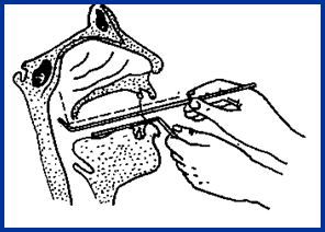 耳鼻喉头灯怎么用几种常用的耳鼻喉科检查方法！_https://www.jmylbn.com_新闻资讯_第13张