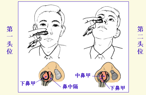 耳鼻喉头灯怎么用几种常用的耳鼻喉科检查方法！_https://www.jmylbn.com_新闻资讯_第11张