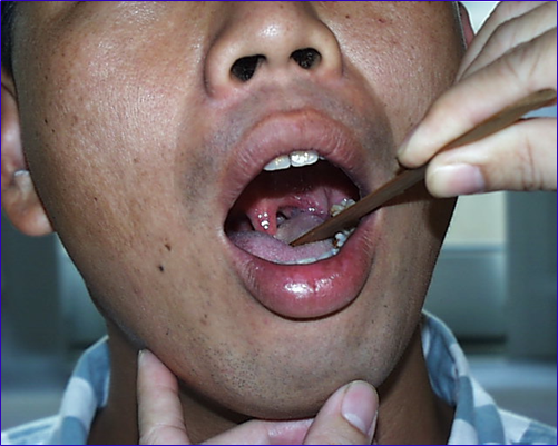 耳鼻喉头灯怎么用实用干货！耳鼻咽喉的检查方法，你都掌握了吗？_https://www.jmylbn.com_新闻资讯_第22张