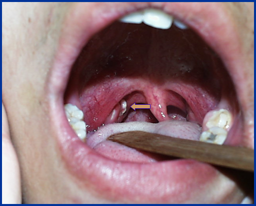 耳鼻喉头灯怎么用几种常用的耳鼻喉科检查方法！_https://www.jmylbn.com_新闻资讯_第25张