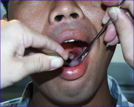 耳鼻喉头灯怎么用实用干货！耳鼻咽喉的检查方法，你都掌握了吗？_https://www.jmylbn.com_新闻资讯_第14张