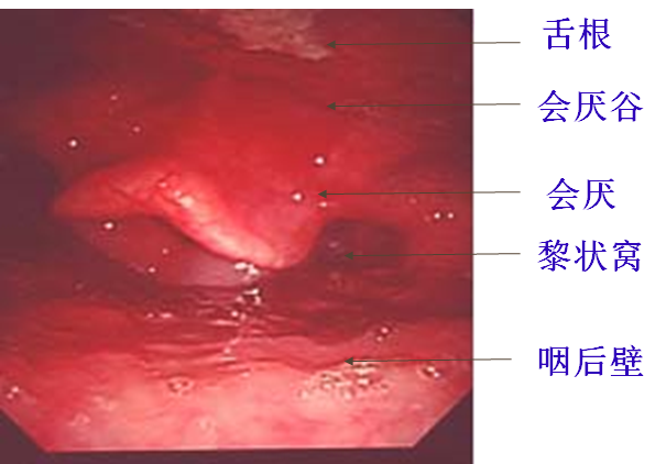 耳鼻喉头灯怎么用几种常用的耳鼻喉科检查方法！_https://www.jmylbn.com_新闻资讯_第32张