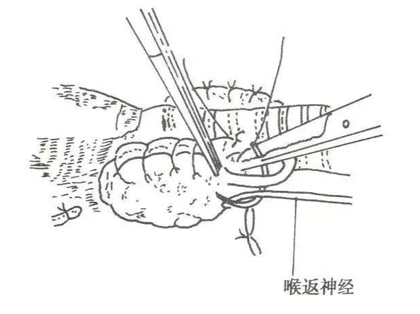 手术室体位垫怎么用手术精讲：图文详解甲状腺手术（含腔镜下手术）_https://www.jmylbn.com_新闻资讯_第14张