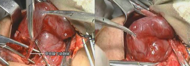 手术室体位垫怎么用手术精讲：图文详解甲状腺手术（含腔镜下手术）_https://www.jmylbn.com_新闻资讯_第24张