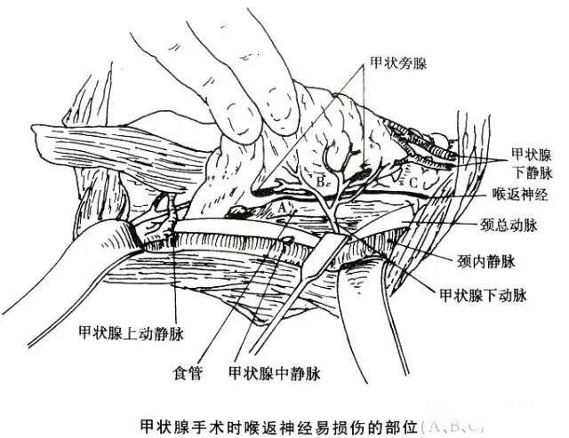 手术室体位垫怎么用手术精讲：图文详解甲状腺手术（含腔镜下手术）_https://www.jmylbn.com_新闻资讯_第11张