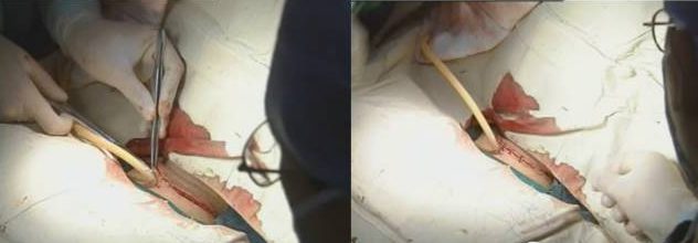 手术室体位垫怎么用手术精讲：图文详解甲状腺手术（含腔镜下手术）_https://www.jmylbn.com_新闻资讯_第30张