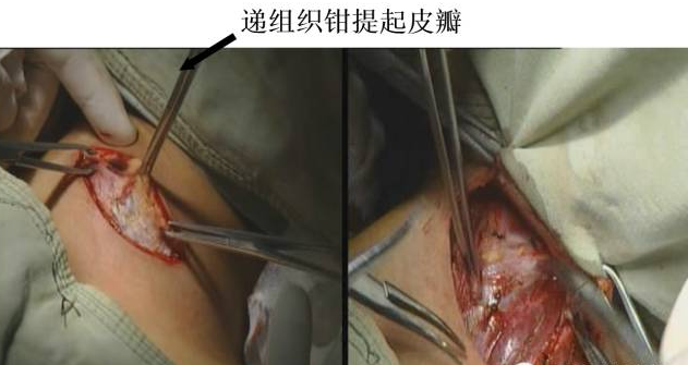 手术室体位垫怎么用手术精讲：图文详解甲状腺手术（含腔镜下手术）_https://www.jmylbn.com_新闻资讯_第20张