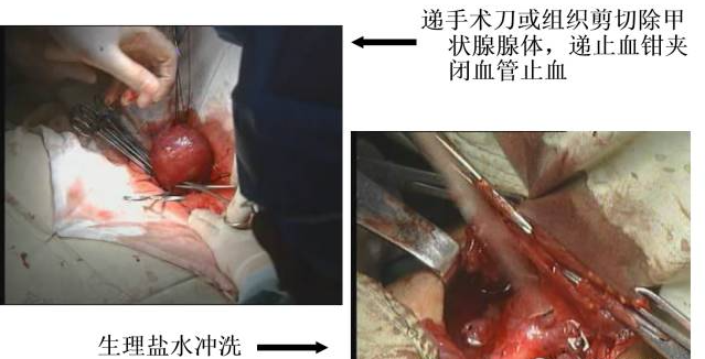 手术室体位垫怎么用手术精讲：图文详解甲状腺手术（含腔镜下手术）_https://www.jmylbn.com_新闻资讯_第27张