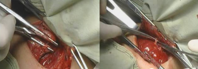 手术室体位垫怎么用手术精讲：图文详解甲状腺手术（含腔镜下手术）_https://www.jmylbn.com_新闻资讯_第21张