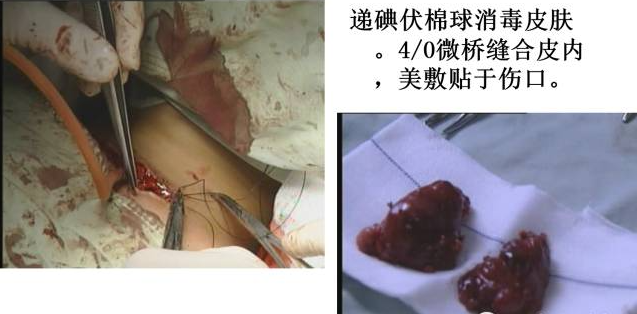 手术室体位垫怎么用手术精讲：图文详解甲状腺手术（含腔镜下手术）_https://www.jmylbn.com_新闻资讯_第29张