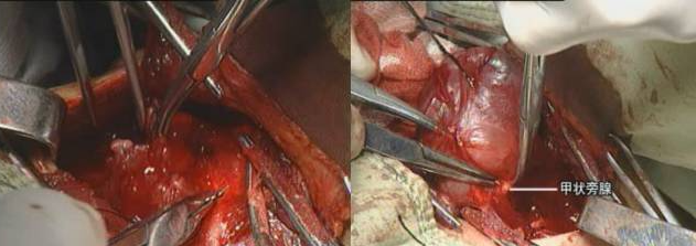 手术室体位垫怎么用手术精讲：图文详解甲状腺手术（含腔镜下手术）_https://www.jmylbn.com_新闻资讯_第26张
