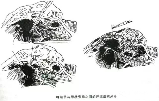 手术室体位垫怎么用手术精讲：图文详解甲状腺手术（含腔镜下手术）_https://www.jmylbn.com_新闻资讯_第12张