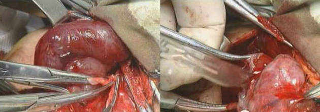 手术室体位垫怎么用手术精讲：图文详解甲状腺手术（含腔镜下手术）_https://www.jmylbn.com_新闻资讯_第25张