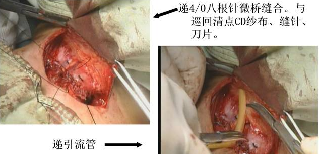 手术室体位垫怎么用手术精讲：图文详解甲状腺手术（含腔镜下手术）_https://www.jmylbn.com_新闻资讯_第28张