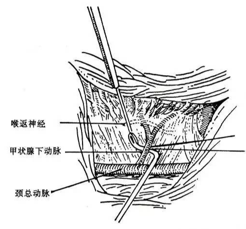 手术室体位垫怎么用手术精讲：图文详解甲状腺手术（含腔镜下手术）_https://www.jmylbn.com_新闻资讯_第17张