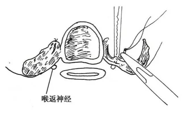 手术室体位垫怎么用手术精讲：图文详解甲状腺手术（含腔镜下手术）_https://www.jmylbn.com_新闻资讯_第13张