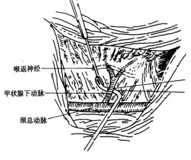 手术室体位垫怎么用手术精讲：图文详解甲状腺手术（含腔镜下手术）_https://www.jmylbn.com_新闻资讯_第15张