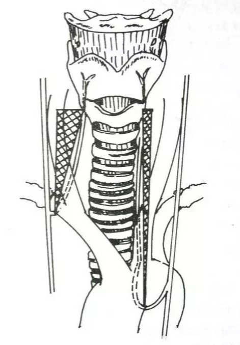 手术室体位垫怎么用手术精讲：图文详解甲状腺手术（含腔镜下手术）_https://www.jmylbn.com_新闻资讯_第19张