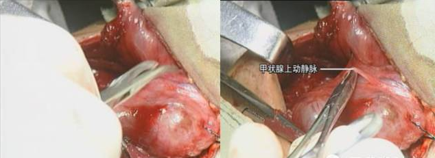 手术室体位垫怎么用手术精讲：图文详解甲状腺手术（含腔镜下手术）_https://www.jmylbn.com_新闻资讯_第23张