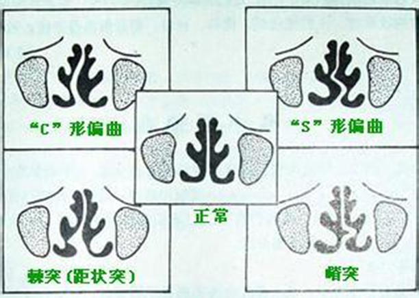 鼻内镜手术是小手术嘛_鼻中隔偏曲手术有几种_鼻中隔向左侧偏曲