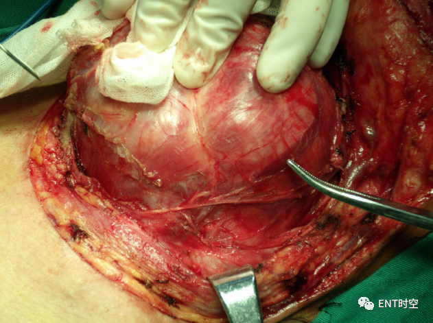 手术室体位垫怎么用手术精讲：图文详解甲状腺手术（含腔镜下手术）_https://www.jmylbn.com_新闻资讯_第2张