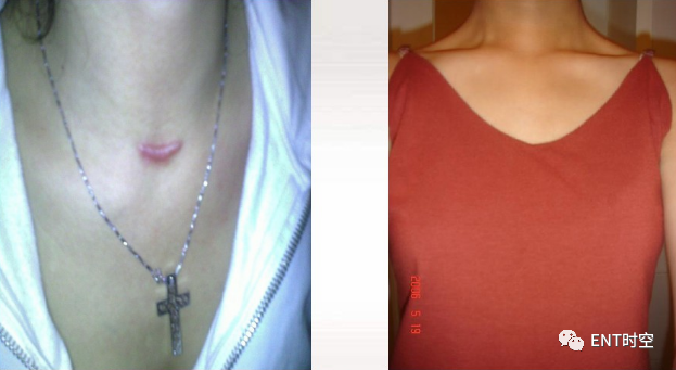 手术室体位垫怎么用手术精讲：图文详解甲状腺手术（含腔镜下手术）_https://www.jmylbn.com_新闻资讯_第31张