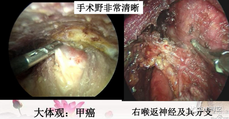 手术室体位垫怎么用手术精讲：图文详解甲状腺手术（含腔镜下手术）_https://www.jmylbn.com_新闻资讯_第32张