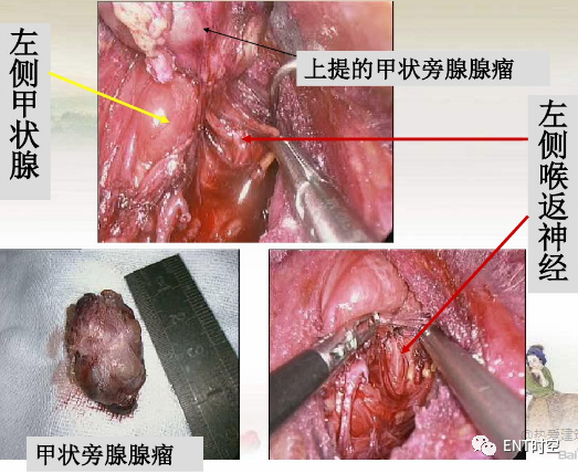 手术室体位垫怎么用手术精讲：图文详解甲状腺手术（含腔镜下手术）_https://www.jmylbn.com_新闻资讯_第34张