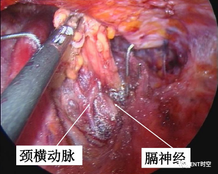 手术室体位垫怎么用手术精讲：图文详解甲状腺手术（含腔镜下手术）_https://www.jmylbn.com_新闻资讯_第36张