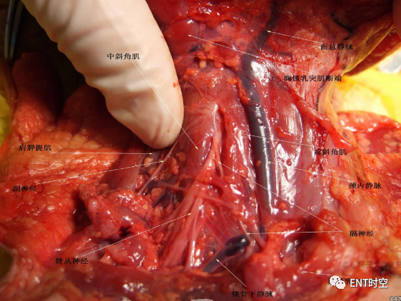 手术室体位垫怎么用手术精讲：图文详解甲状腺手术（含腔镜下手术）_https://www.jmylbn.com_新闻资讯_第10张