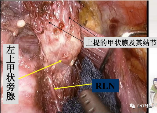 手术室体位垫怎么用手术精讲：图文详解甲状腺手术（含腔镜下手术）_https://www.jmylbn.com_新闻资讯_第33张
