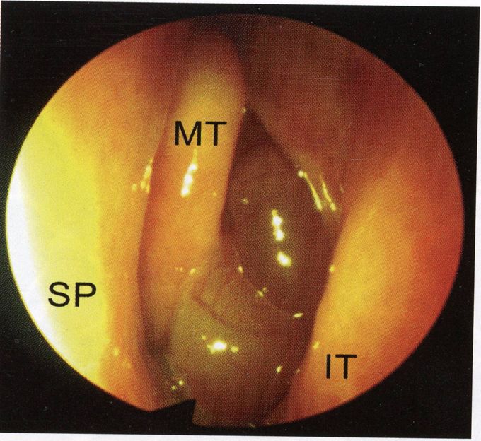 耳鼻喉镜篇鼻息肉