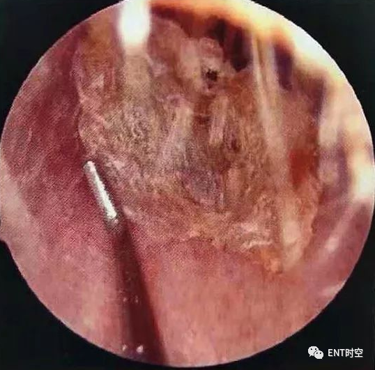 耵聍栓塞到底该怎样规范治疗