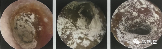 图文并茂耳真菌病：小疾病彰显真功夫！