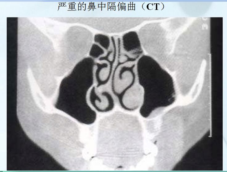 鼻中隔偏曲