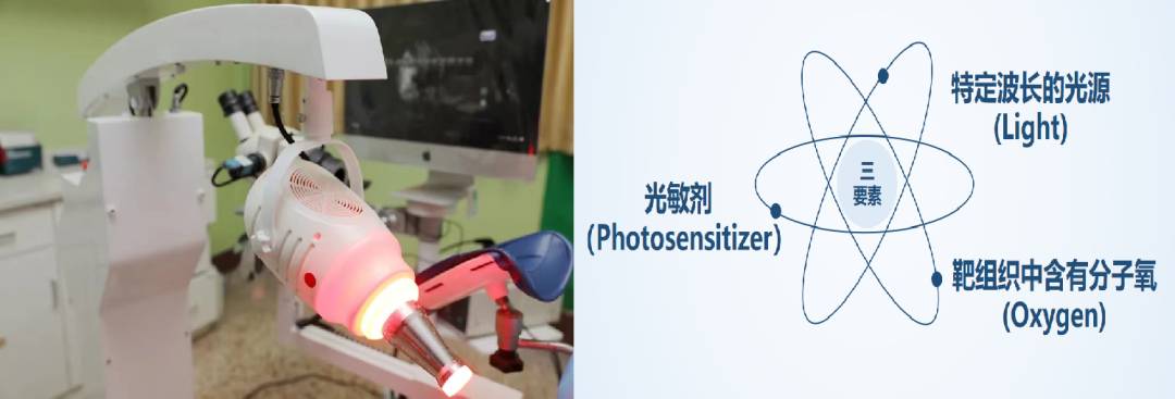 宫颈光是什么意思光动力——让宫颈上皮内瘤变在“光”下无处遁形_https://www.jmylbn.com_新闻资讯_第44张