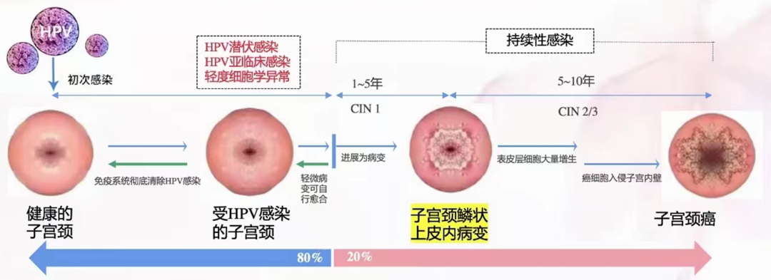 宫颈光是什么意思光动力——让宫颈上皮内瘤变在“光”下无处遁形_https://www.jmylbn.com_新闻资讯_第4张