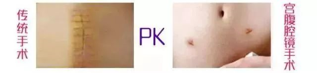 德国宫腔镜有什么牌子【微创时代】看不到疤痕的腹腔镜手术 开启妇产微创诊疗新“视”界！_https://www.jmylbn.com_新闻资讯_第3张