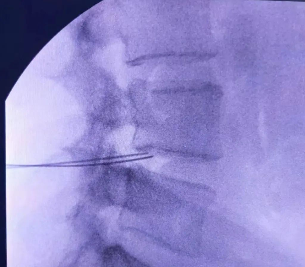 射频什么科【图文解析】疼痛科常用的射频治疗是什么疗法？可以治疗什么疾病？_https://www.jmylbn.com_新闻资讯_第20张