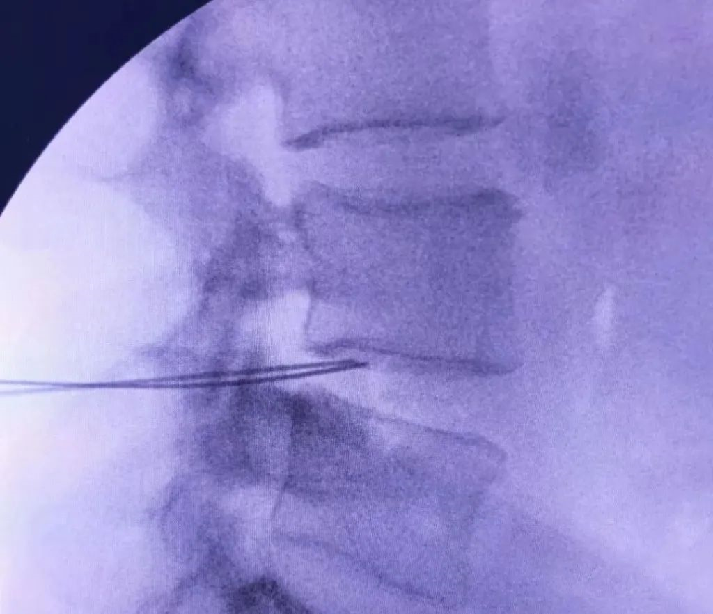 射频什么科【图文解析】疼痛科常用的射频治疗是什么疗法？可以治疗什么疾病？_https://www.jmylbn.com_新闻资讯_第22张