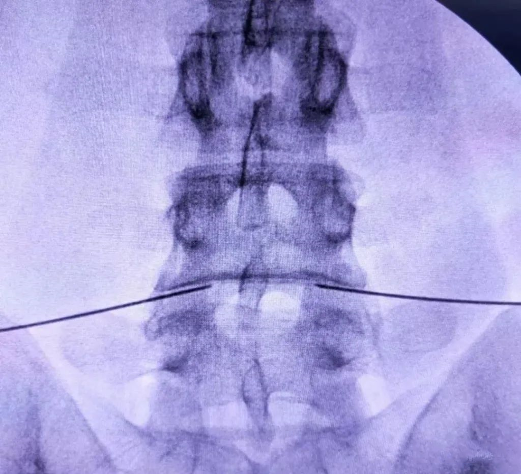 射频什么科【图文解析】疼痛科常用的射频治疗是什么疗法？可以治疗什么疾病？_https://www.jmylbn.com_新闻资讯_第21张