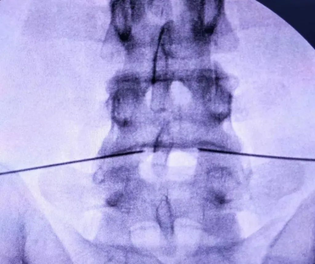 射频什么科【图文解析】疼痛科常用的射频治疗是什么疗法？可以治疗什么疾病？_https://www.jmylbn.com_新闻资讯_第23张