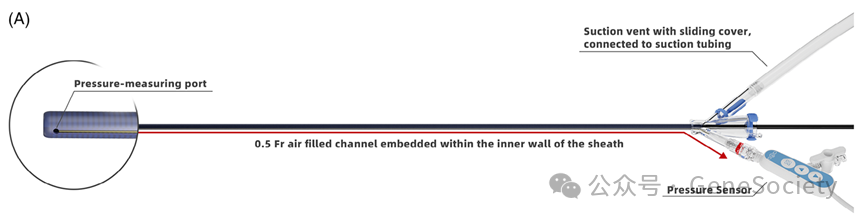 输尿管鞘是什么CTD期刊 ｜ 新突破！实时监测肾内压，新型输尿管鞘让肾结石手术更高效、更安全_https://www.jmylbn.com_新闻资讯_第4张